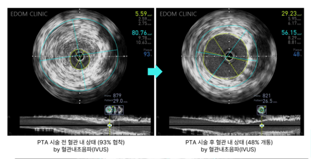 IVUS 혈관내초음파검사 전후.png