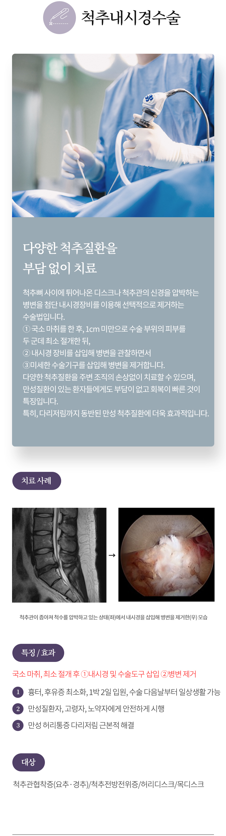 척추내시경수술