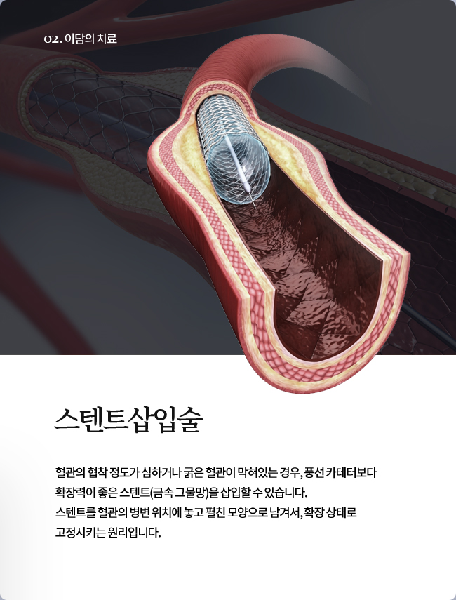 스텐트삽입술