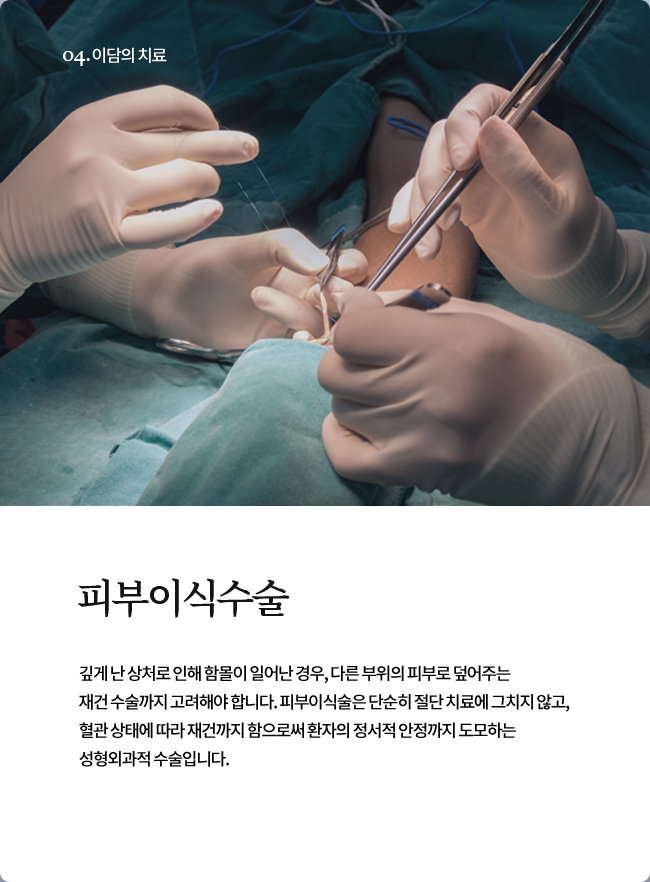 피부이식수술