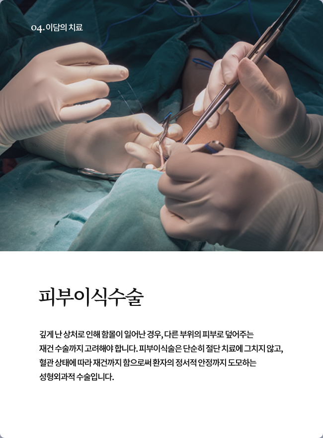 피부이식수술