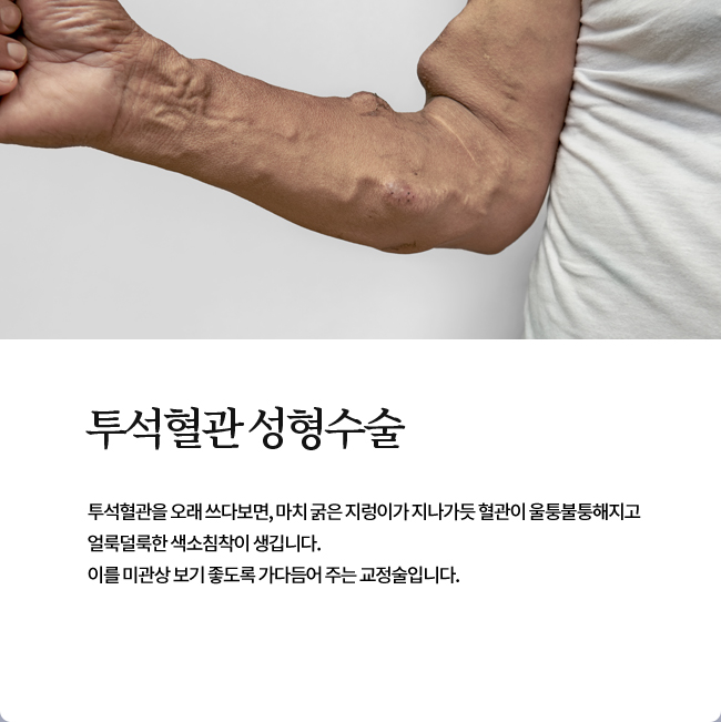 투석혈관 성형수술