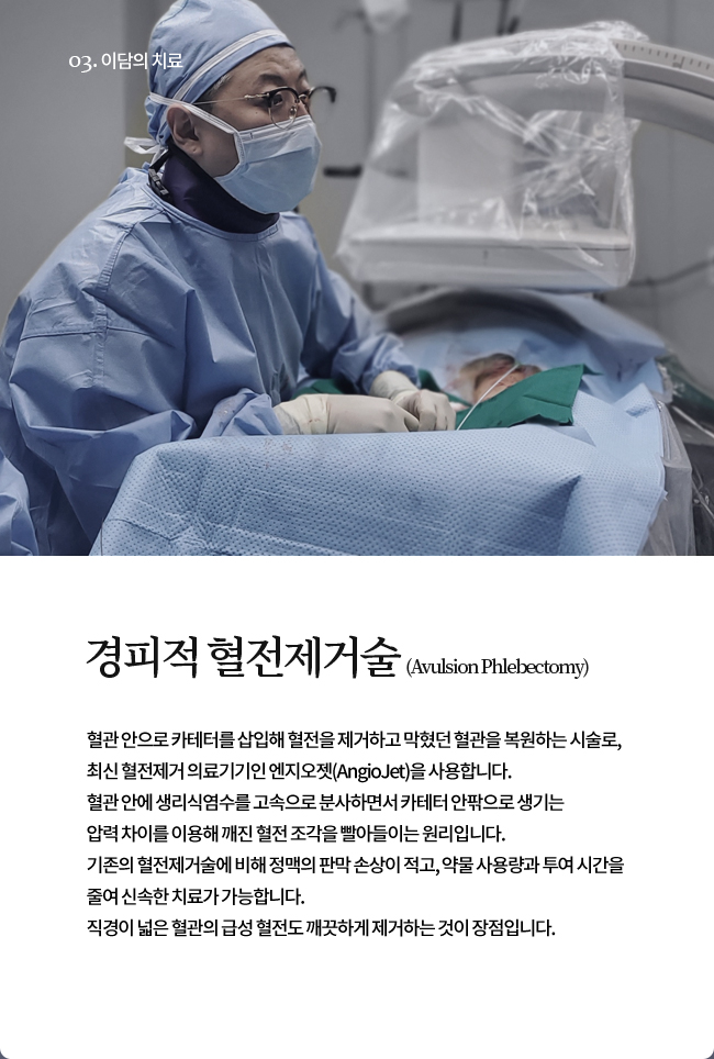 경피적 혈전제거술(Avulsion Phlebectomy)