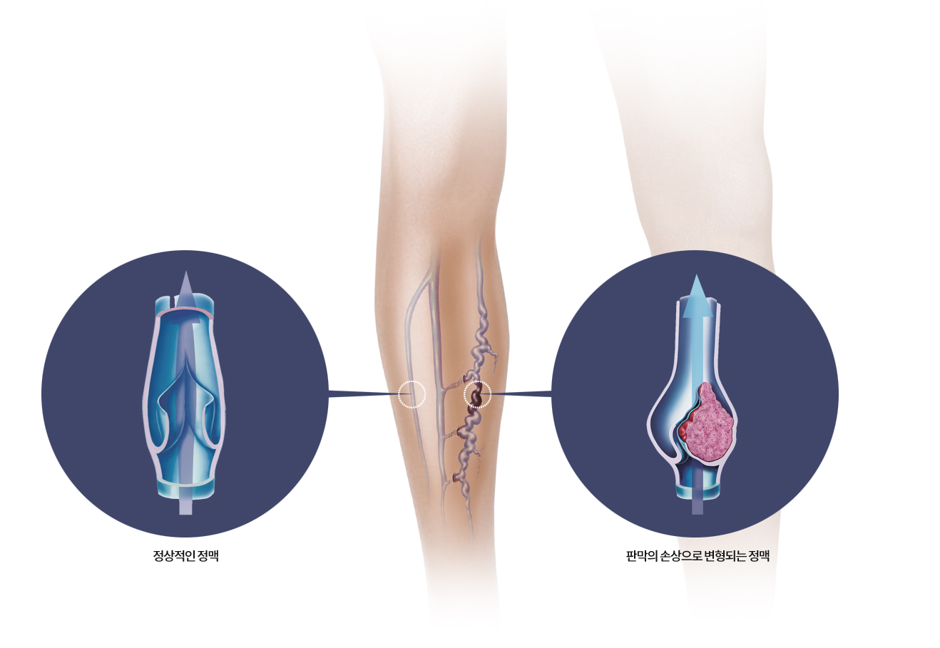 하지정맥류의 원인