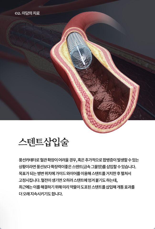 스텐트삽입술