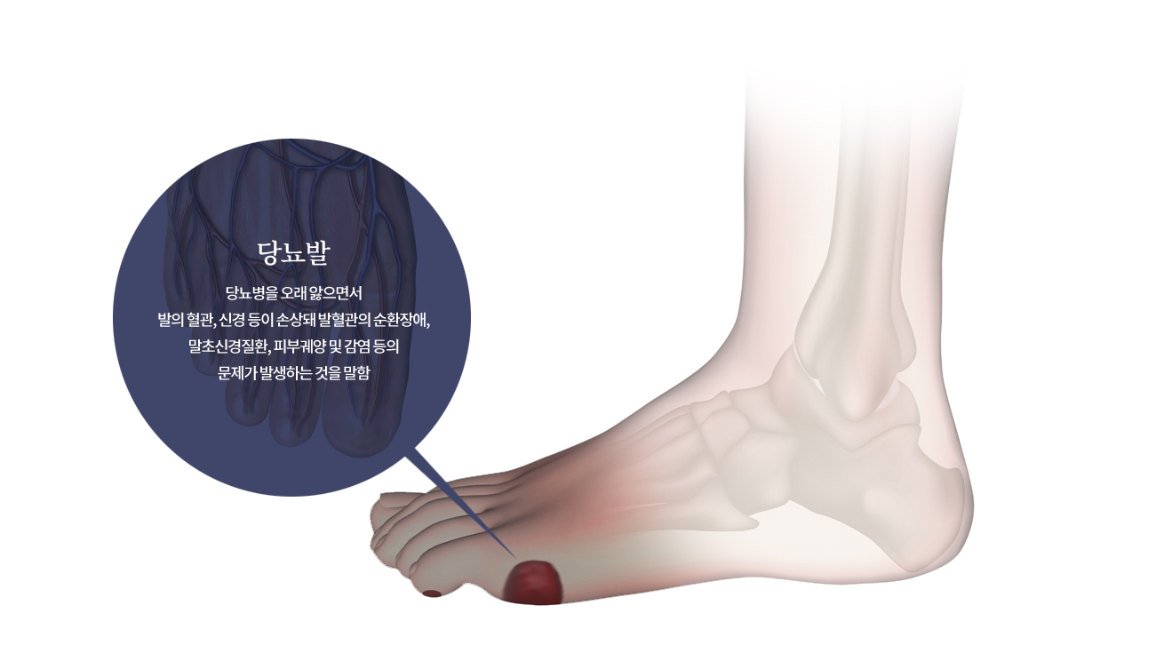 당뇨발의 원인