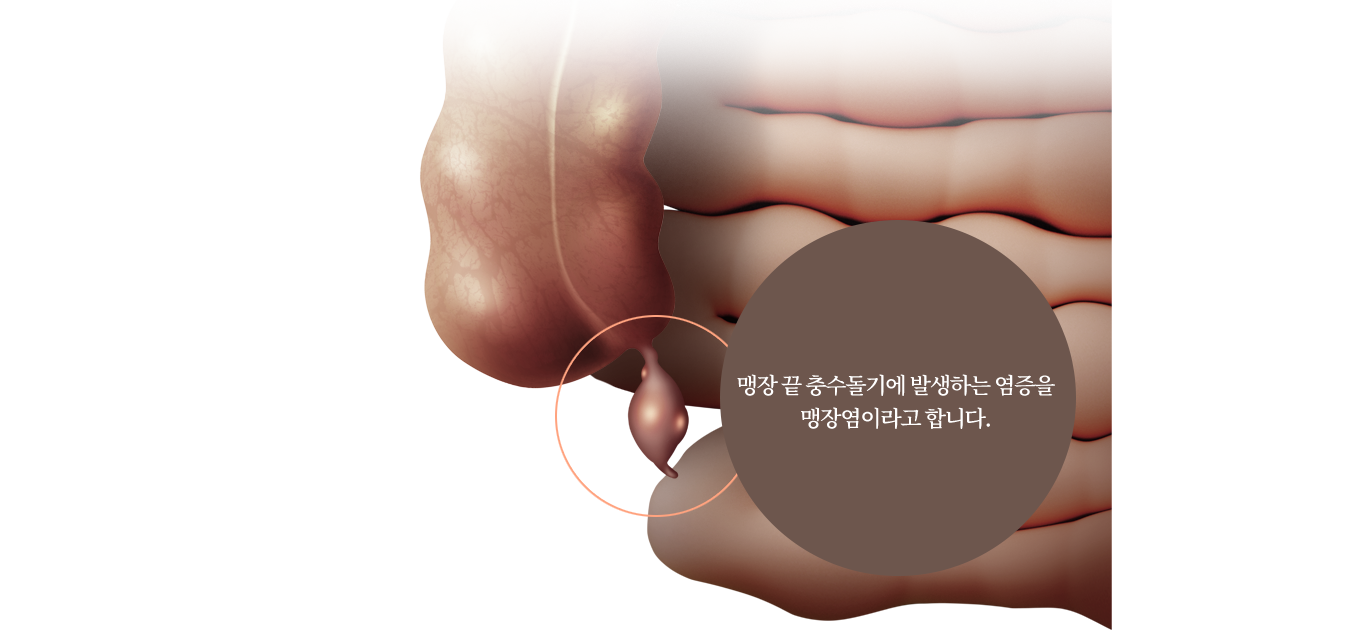 맹장 끝 충수돌기에 발생하는 염증을 맹장염이라고 합니다.